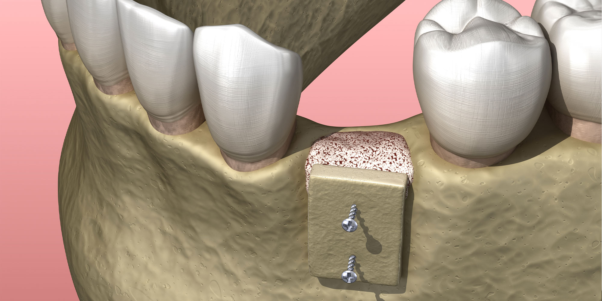 bone graft 3d medically accurate graphic